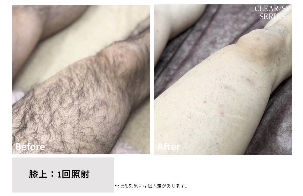 メンズ脱毛施術写真1