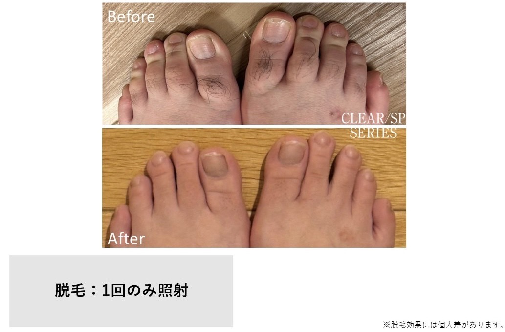 メンズ脱毛施術写真3