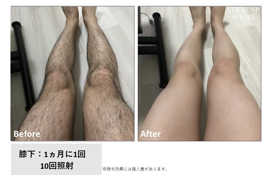 メンズ脱毛施術写真11