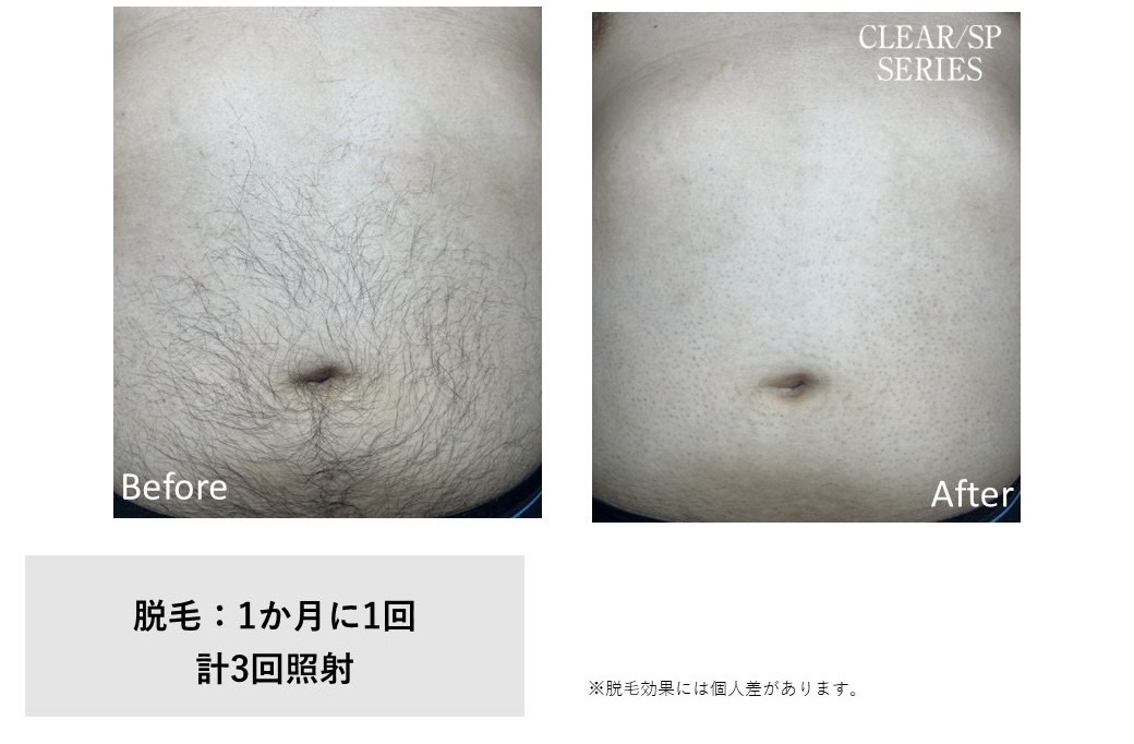 メンズ脱毛施術写真14