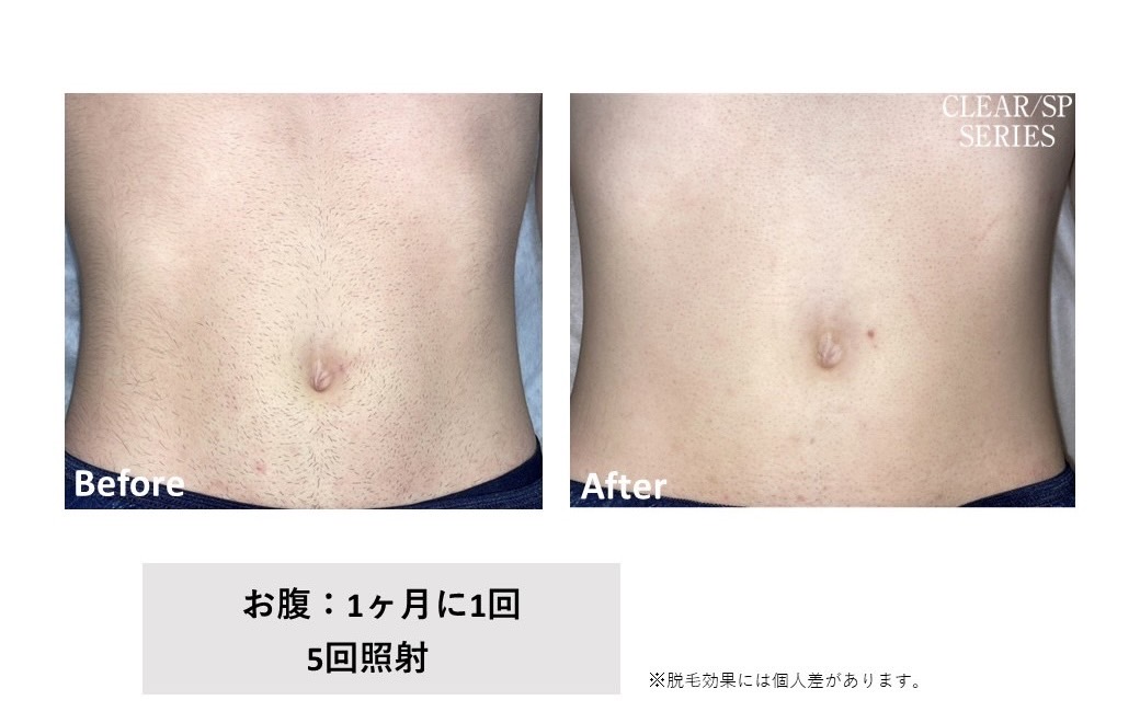 メンズ脱毛施術写真16