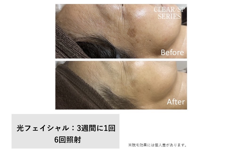 レディース脱毛施術写真15