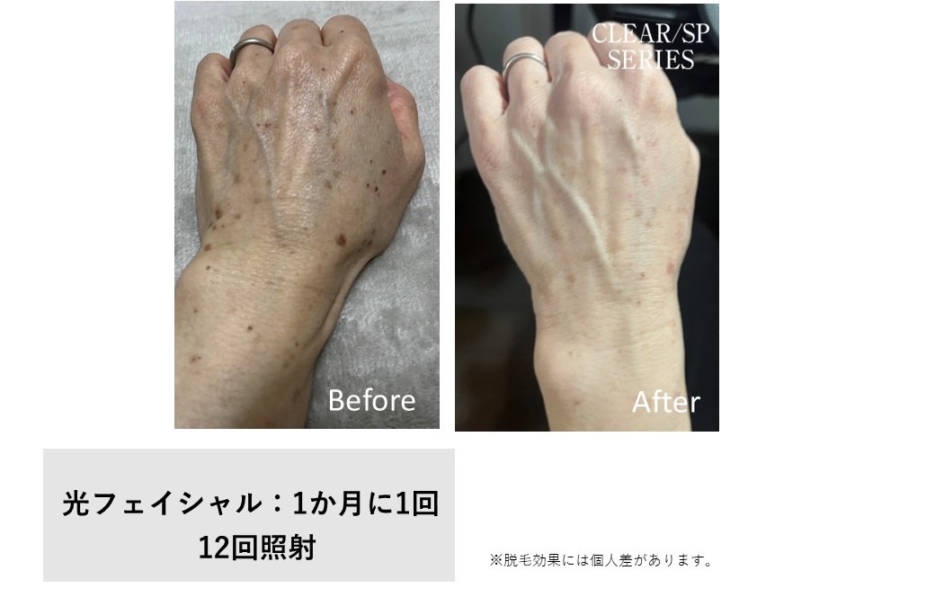 レディース脱毛施術写真16