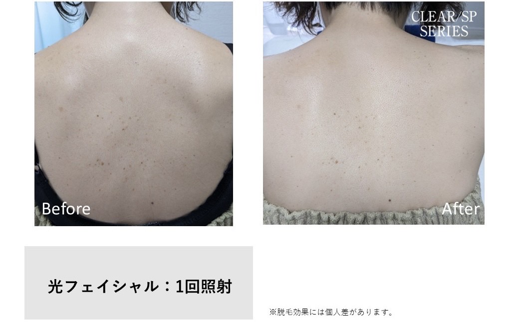 レディース脱毛施術写真17