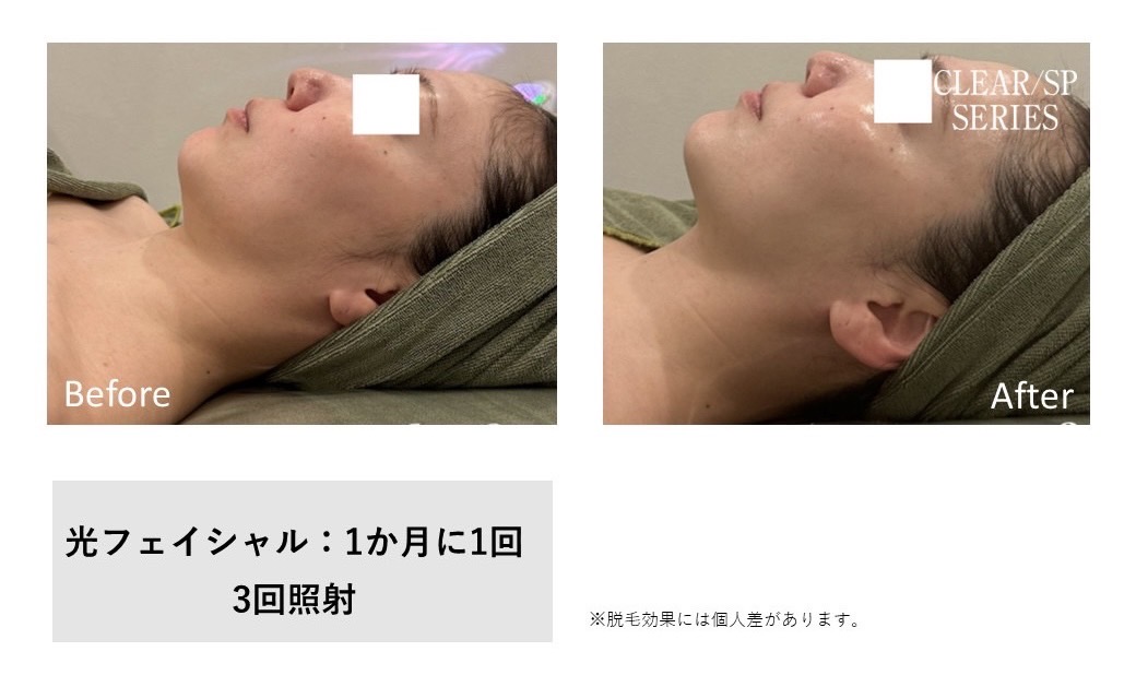 レディース脱毛施術写真20