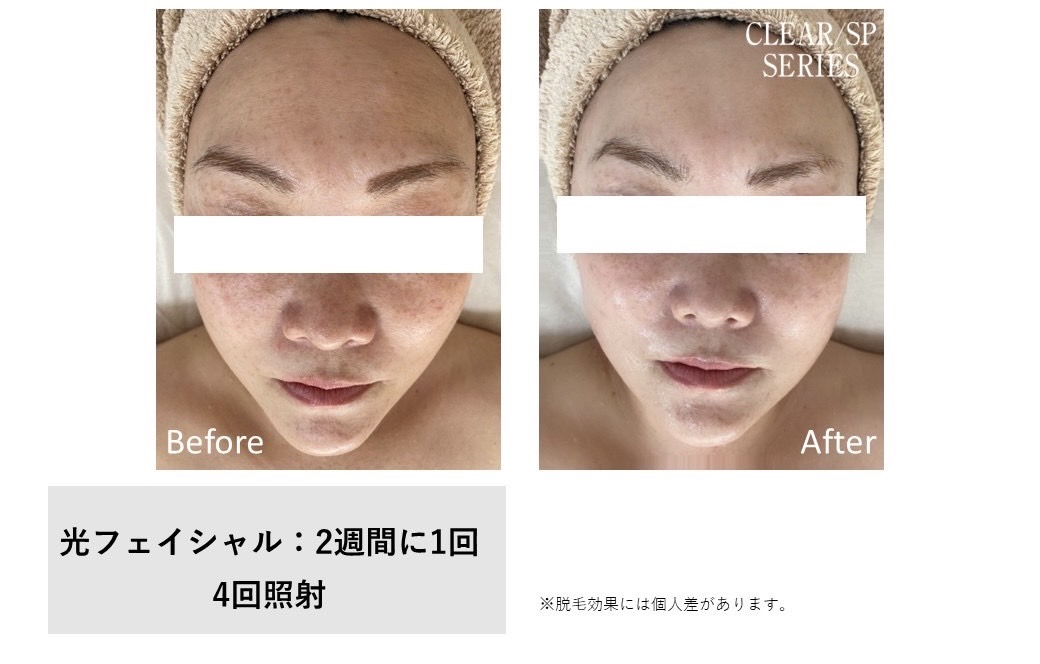 レディース脱毛施術写真21