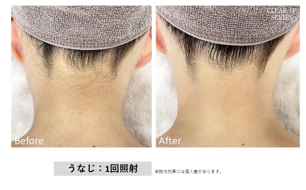 レディース脱毛施術写真2