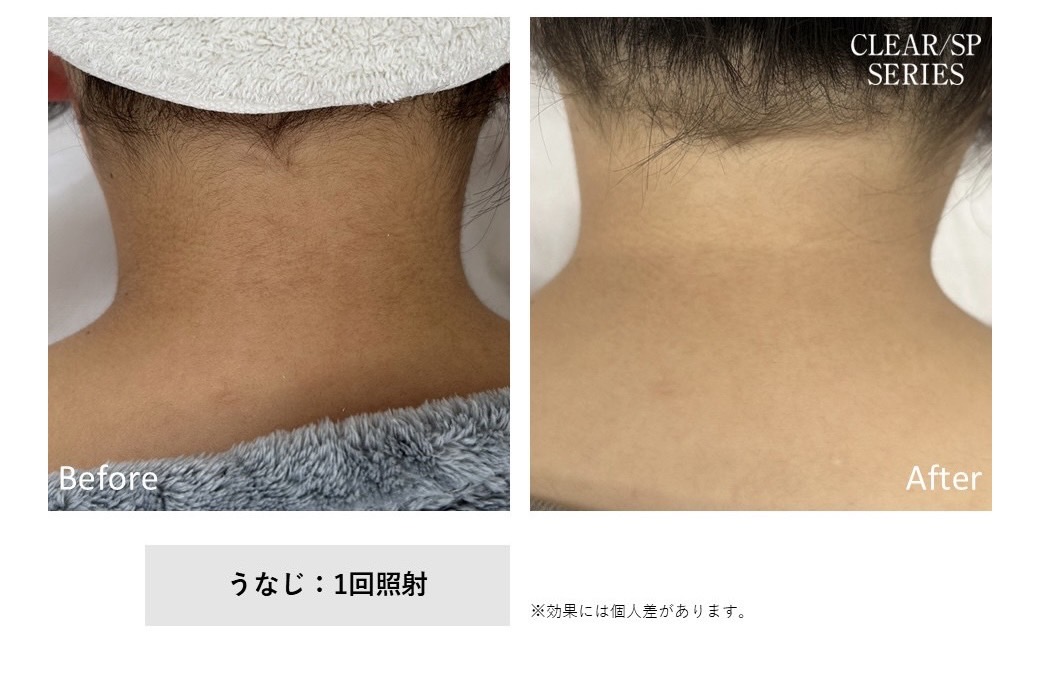 レディース脱毛施術写真3