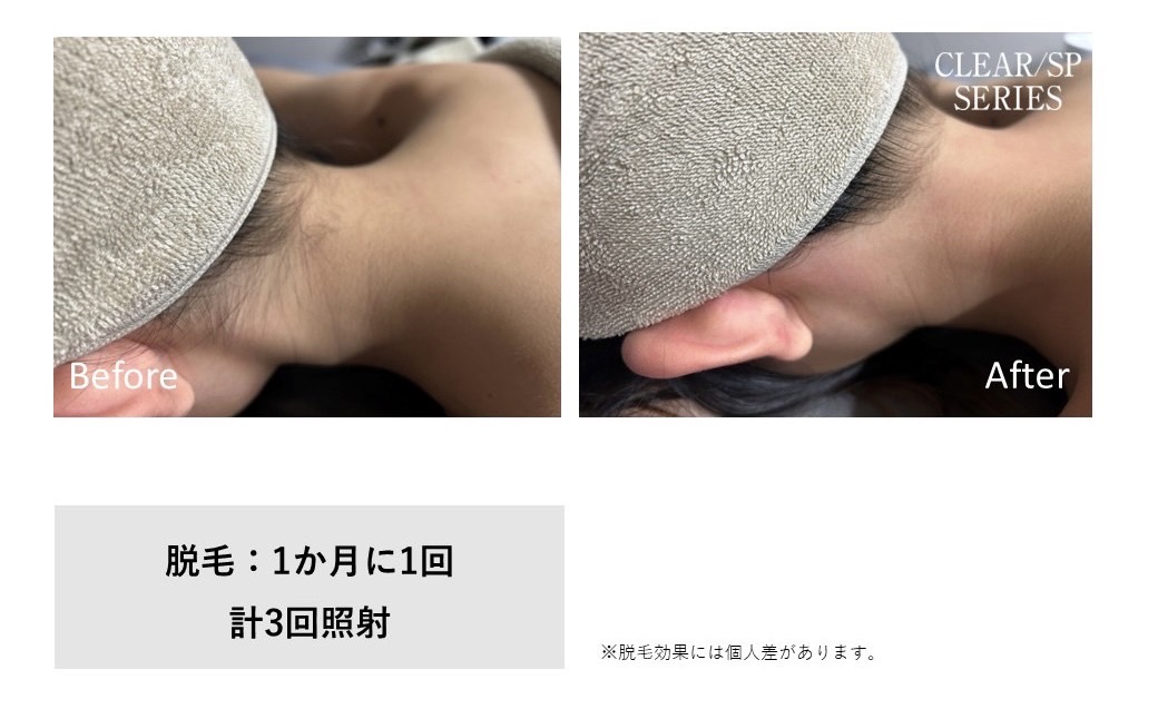 レディース脱毛施術写真5