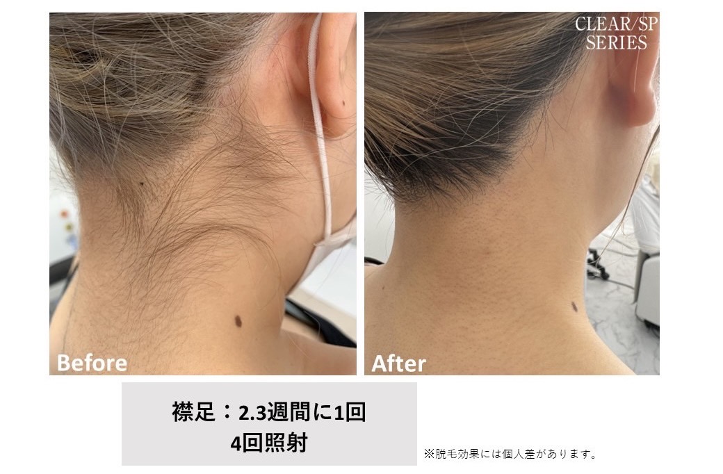 レディース脱毛施術写真6