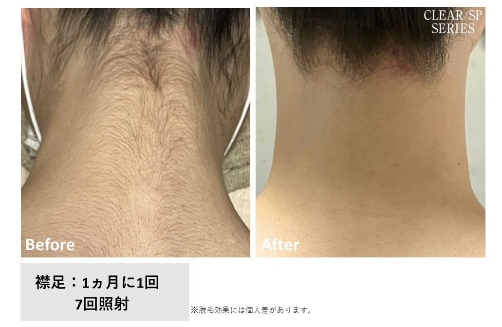 レディース脱毛施術写真8