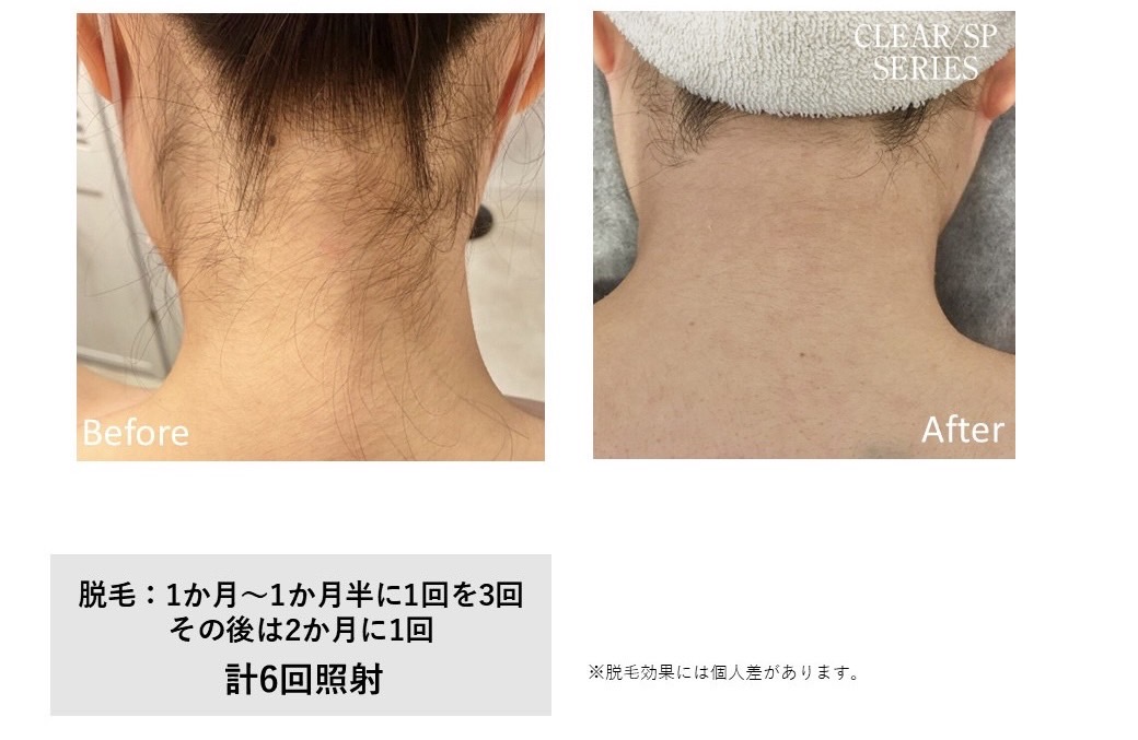 レディース脱毛施術写真10